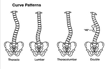 Scoliosis